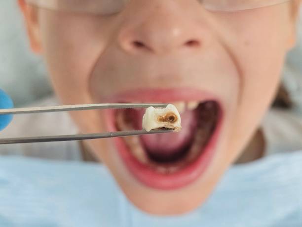 Best Emergency Dental Care for Broken or Chipped Teeth in Seabrook Island, SC